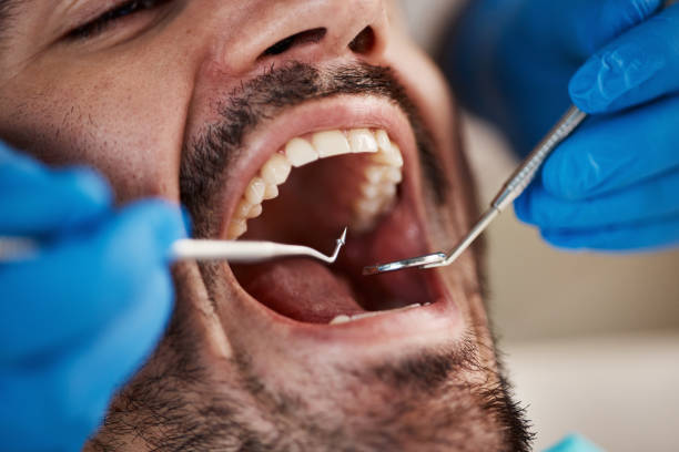 Best Emergency Dentist for Knocked-Out Tooth in Willow Springs, MO